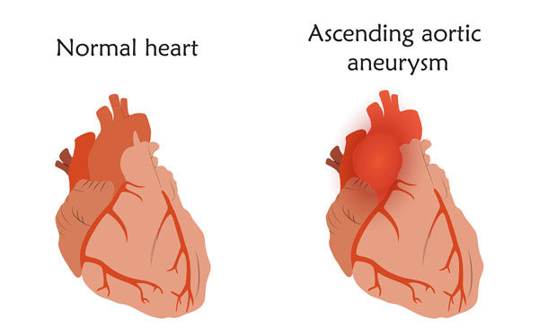 Normal and Ascending Aortic Aneurysm