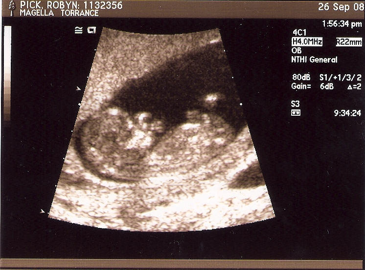 Ultrasound Picture Of Adam's Baby Boy - 12 Weeks