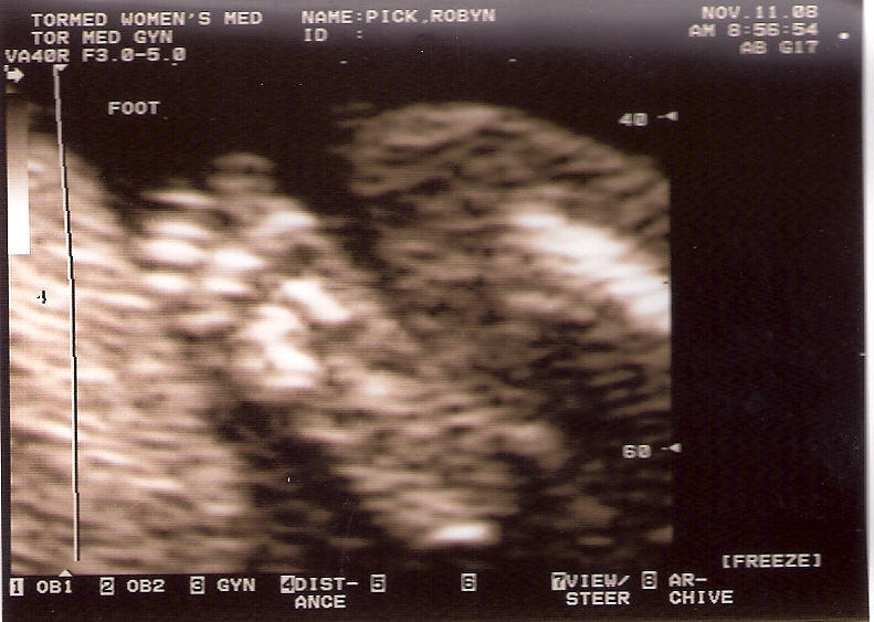 Baby Pick At 18 Weeks - View Of Foot Baby Pick At 18 Weeks - View Of Foot