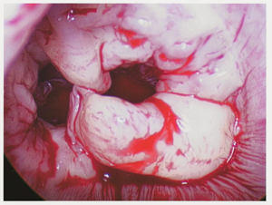 Picture Of Diseased Mitral Valve Before Heart Valve Repair