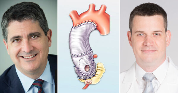 Dr. Eric Roselli and Dr. Marijan Koprivanac - Valve Sparing Aortic Root Replacement