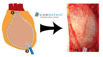 CorMatrix For Heart Adhesions