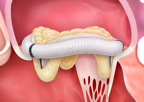 Epic Mitral Valve Replacement Implanted