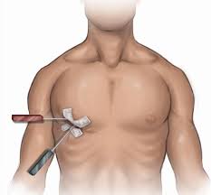 Port access technique for heart valve surgery