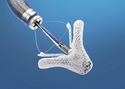Mitraclip device by Abbott