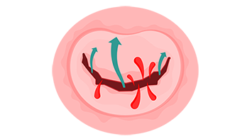 Leaking Heart Valve