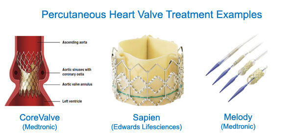 Percutaneous Aortic Valve Implantation Devices