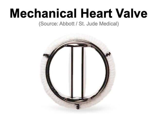 St. Jude Mechanical Heart Valve Replacement