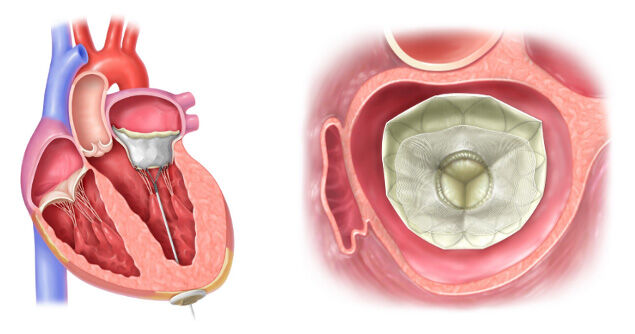 SUMMIT Clinical Trial Enrolling Mitral Regurgitation Patients SUMMIT Clinical Trial Enrolling Mitral Regurgitation Patients