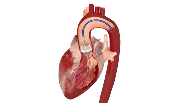 TAVR-in-SAVR anatomical positioning in 3D rendering