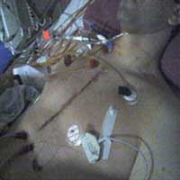 Best Position For Sleep After Heart Surgery (Patient Tip)