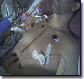 Picture In Intensive Care Unit After Heart Valve Surgery