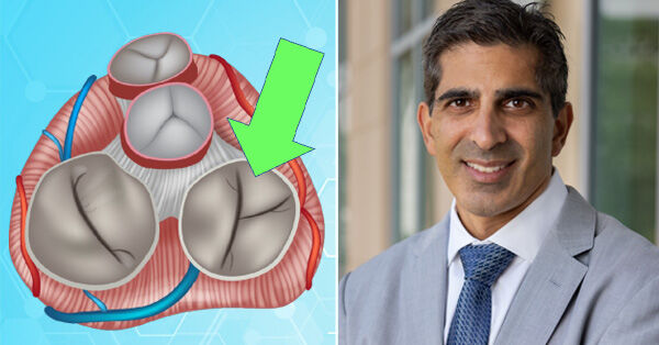 Dr. Gorav Ailawadi - The Forgotten Tricuspid Valve