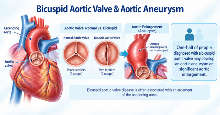 Bicuspid Aortic Valve and Aneurysms Explained with Risk Factors