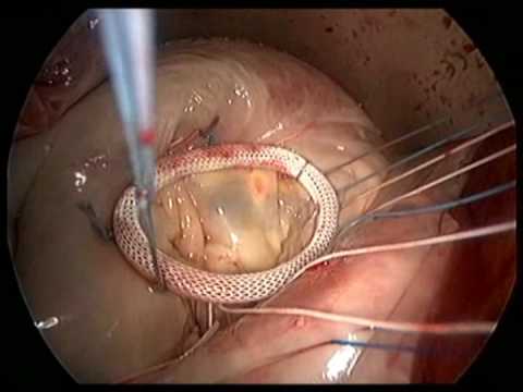 Mitral Valve Repair Annuloplasty Ring Sutured In The Heart