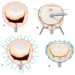 Annuloplasty Ring For Mitral Valve Repair
