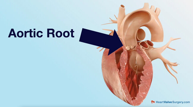 Aortic Root