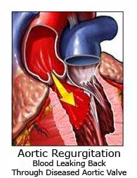 Aortic Valve Regurgitation Backward Bloodflow