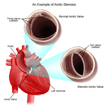 Normal and Bicuspid Aortic Valve