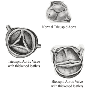 Medical Drawings Of Bicuspid Aortic Valves