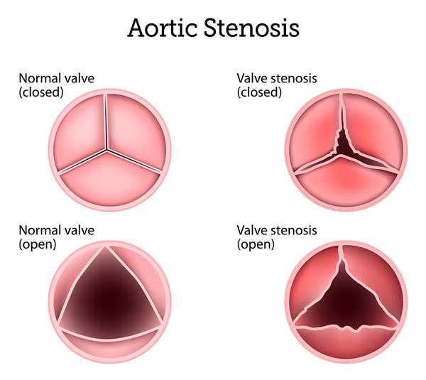 Aortic Stenosis Comparison Diagram