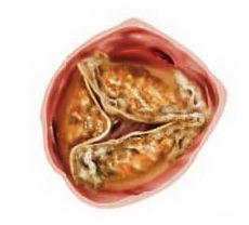 Severely Stenotic Aortic Heart Valve 