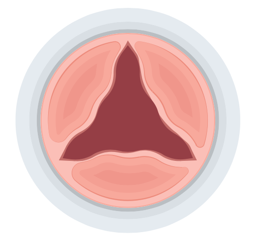 Aortic stenosis