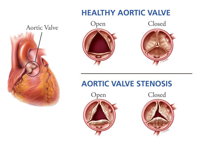 Severe Aortic Stenosis