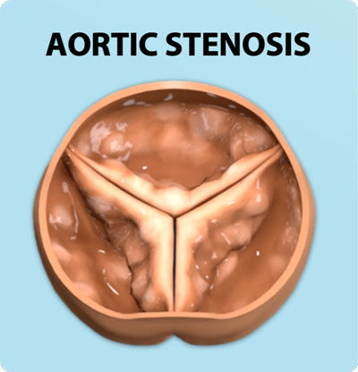 Aortic Stenosis