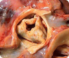 Aortic Stenosis Picture - Defective Aortic Valve That Is Narrowed