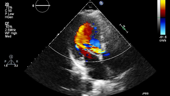 Aortic Valve Echocardiogram
