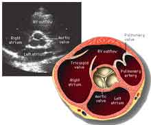 Aortic Stenosis Echocardiogram