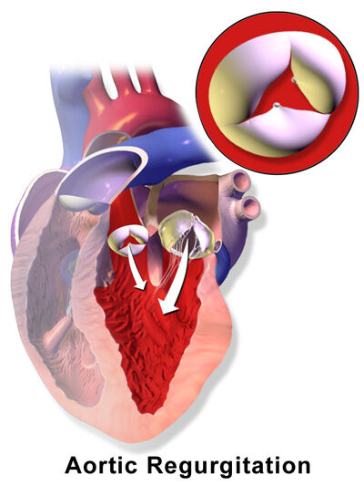 Aortic Valve Regurgitation