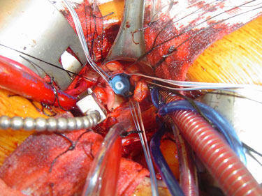 Aortic Valve Replacement Prosthetic Placement