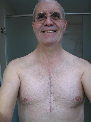 Patient With Incision Down The Middle Of His Chest