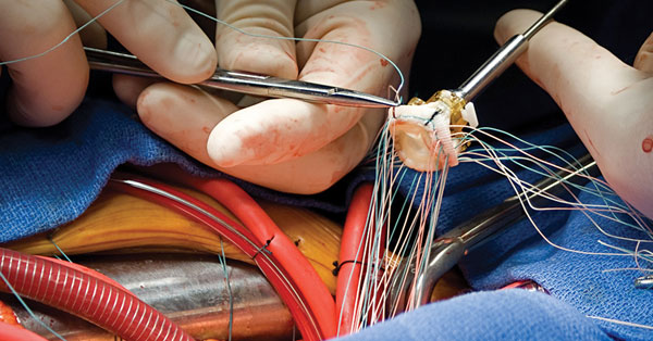 Aortic Valve Replacement Surgery