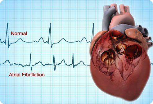 Atrial Fibrillation Complication After Heart Surgery