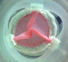 ATS 3F Aortic Bioprosthesis Valve Video