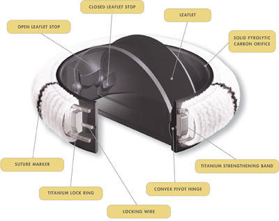 ATS Open Pivot Mechanical Heart Valve Replacement