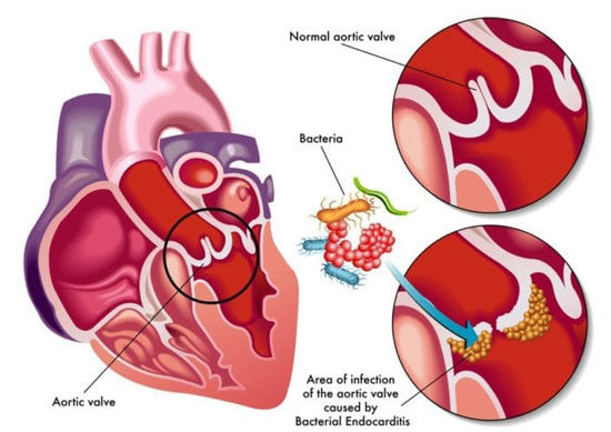 Bacterial Endocarditis in Aortic Heart Valve