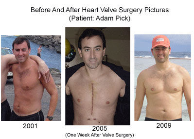 Patient Cardiac Surgery Pictures: Before & After Surgery