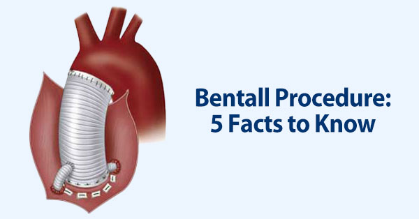 Bentall Procedure Diagram