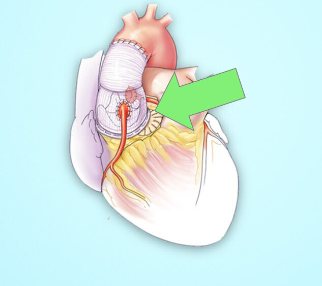 HEART VALVE SURGERY INNOVATION