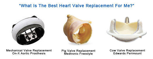 Image Of Different Types Of Heart Valve Replacements