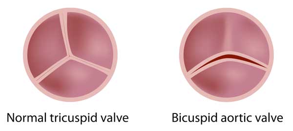 Normal Tricuspid & Bicuspid Aortic Valve Compared