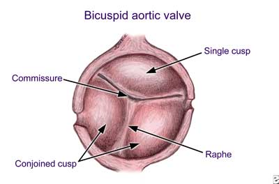 Fused Bicuspid Aortic Valve Showing Commissure