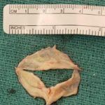 matthew banks heart valve matthew banks heart valve