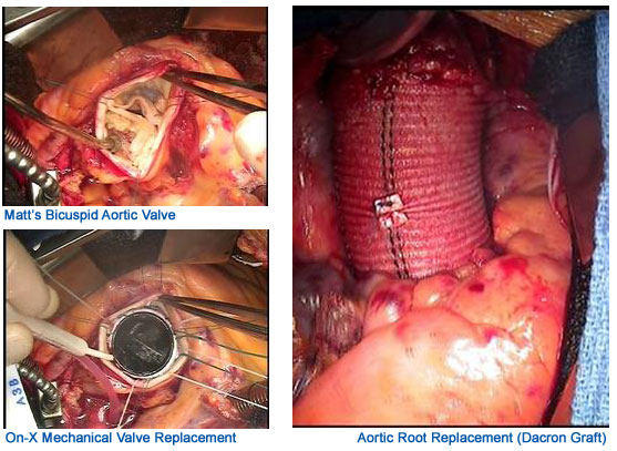 Bicuspid Aortic Valve Replacement With On-X Mechanical Valve Replacement WIth Dacron Graft