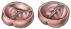 Bicuspid & Tricuspid Aortic Valve Drawings