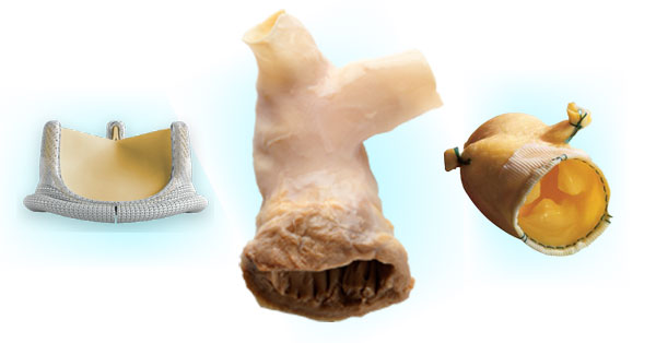 Biological Heart Valve Replacement